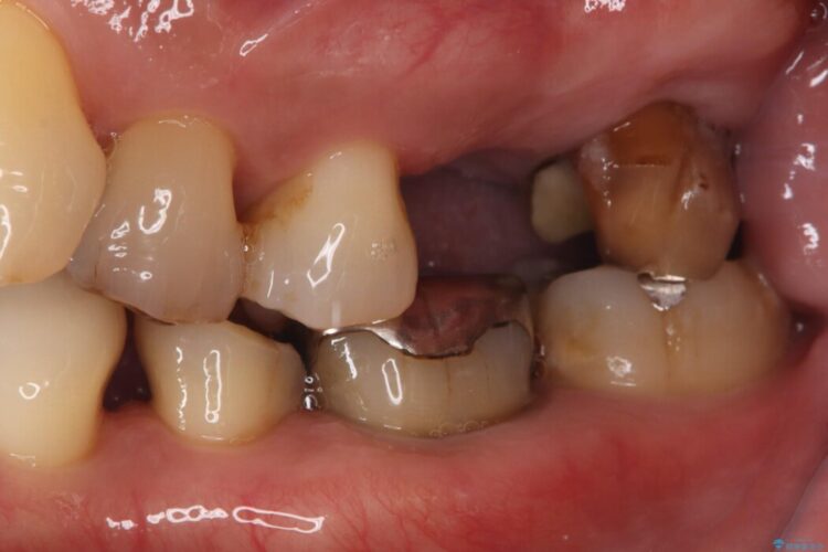 1Dayインプラント治療による咬合の再構築 治療前画像