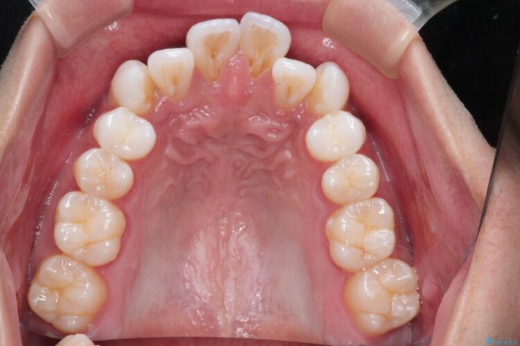 ガタつきと口元の突出感を抜歯ワイヤー矯正で改善 治療前画像