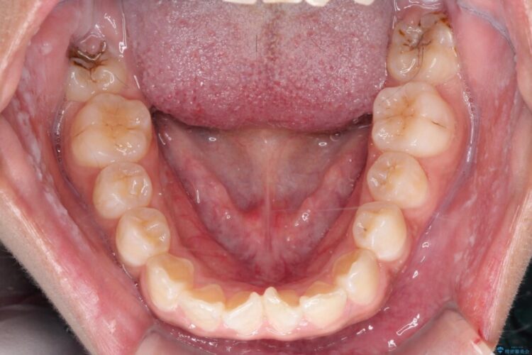 突出感のある口元、抜歯矯正で理想的な横顔に 治療前画像