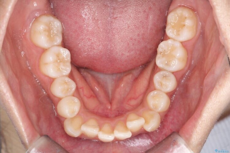 重なり合った歯列を整え、美しい横顔に 治療前画像