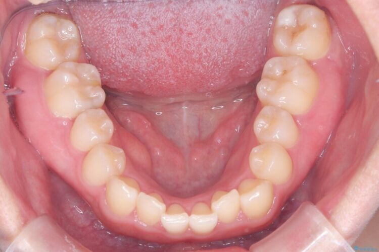 歯を削らない矮小歯を考慮した非抜歯矯正 治療前画像
