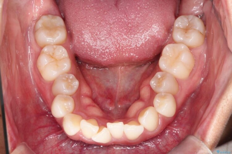 非抜歯で叢生とシザーズバイトの改善 治療前画像