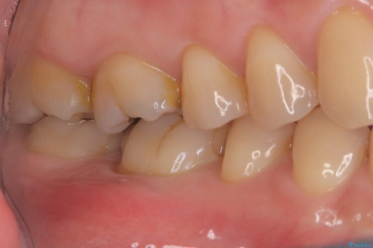 強い痛みと腫れを伴う「曲がった根っこ」を精密根管治療 治療前画像