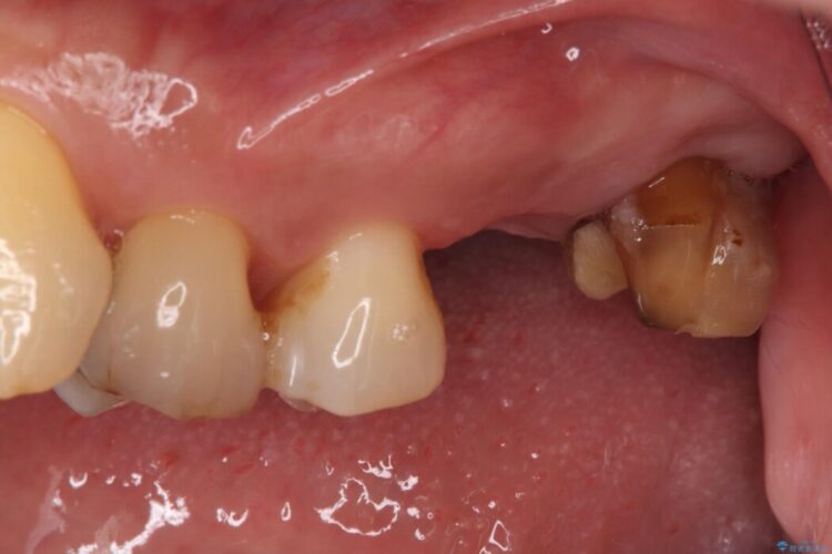 1Dayインプラント治療による咬合の再構築 治療前画像
