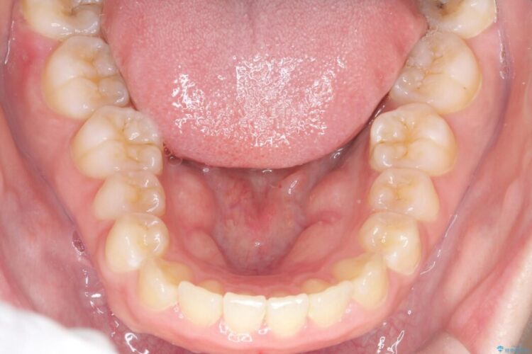 「口元の突出感」を解消。前歯を下げてスッキリした口元へ 治療前画像