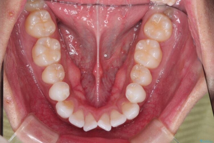 ガタつきと口元の突出感を抜歯ワイヤー矯正で改善 治療前画像