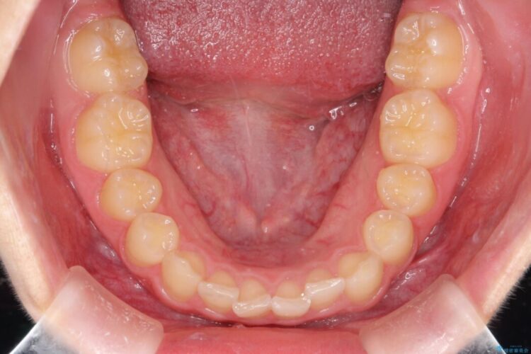 ねじれた前歯を非抜歯ワイヤー矯正で改善 治療前画像