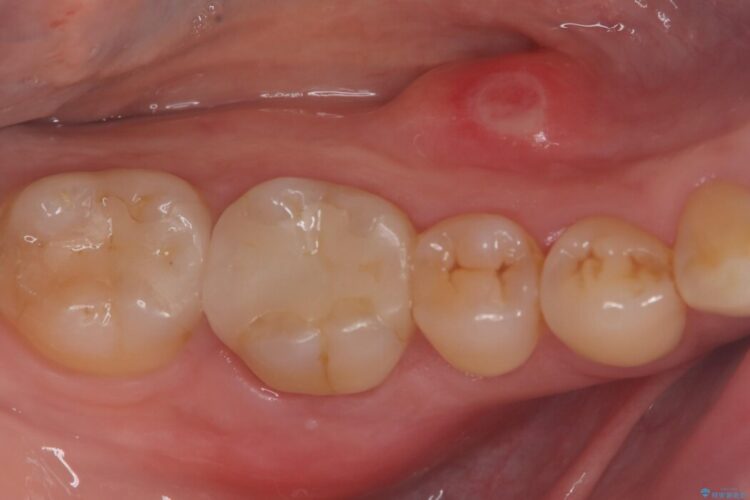 強い痛みと腫れを伴う「曲がった根っこ」を精密根管治療 治療前画像