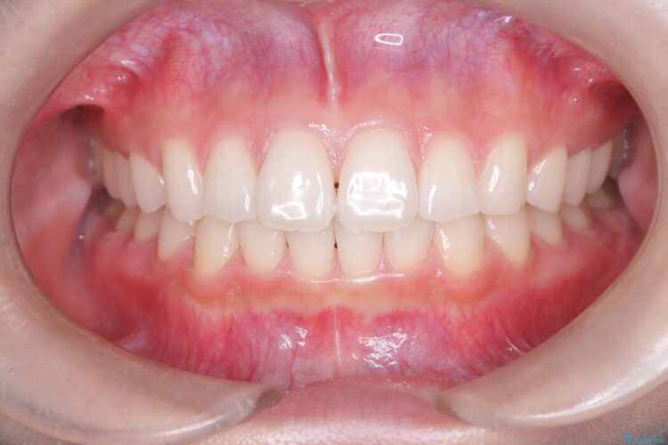 ねじれた前歯を非抜歯ワイヤー矯正で改善 治療後画像