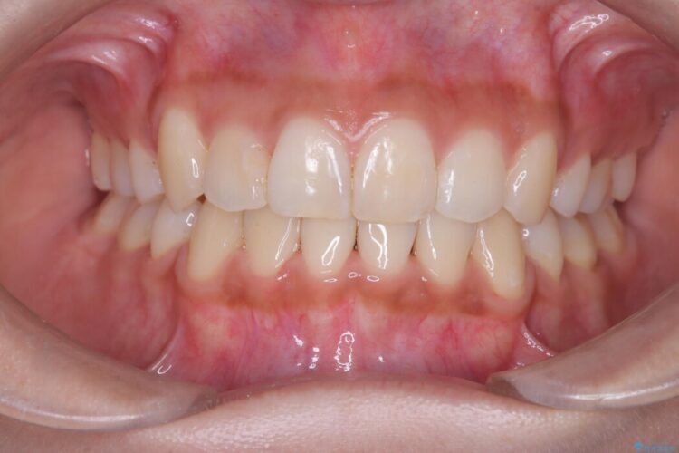 重なり合った歯列を整え、美しい横顔に 治療後画像