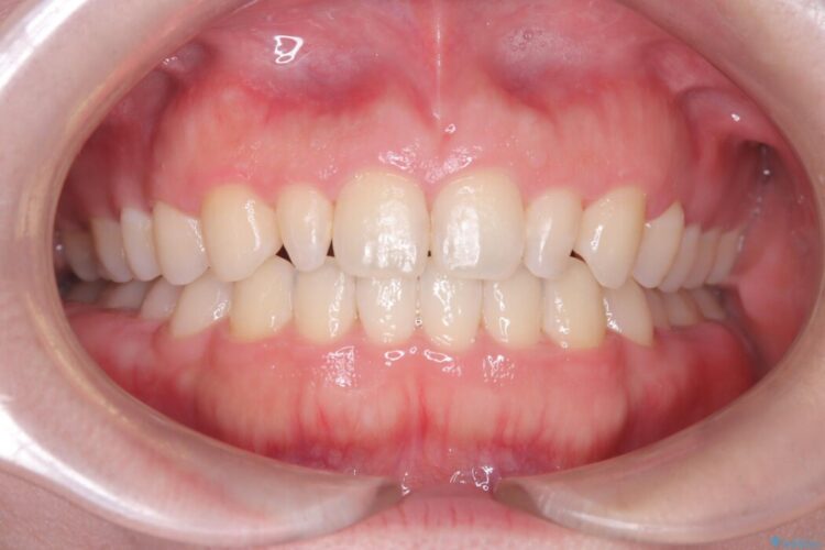 歯を削らない矮小歯を考慮した非抜歯矯正 治療後画像