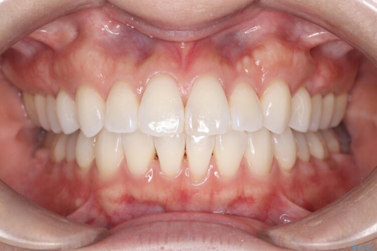 非抜歯で叢生とシザーズバイトの改善 治療後画像