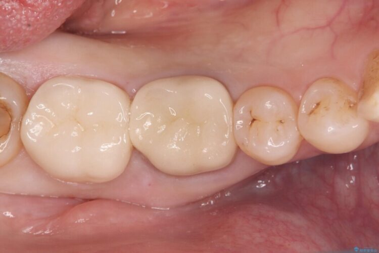 銀歯の下で進行した虫歯、セラミッククラウンでやり替え 治療後画像