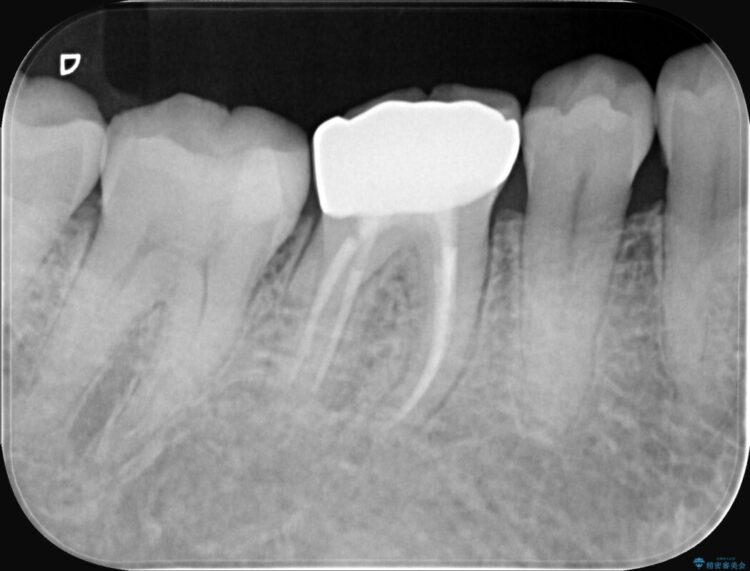 強い痛みと腫れを伴う「曲がった根っこ」を精密根管治療 治療後画像