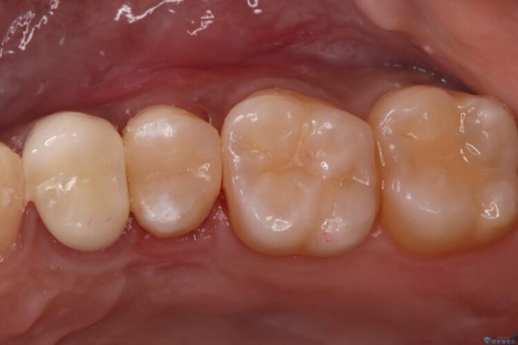 「痛み」を「安心」に。銀歯を外して行う、最新の精密根管治療 治療後画像