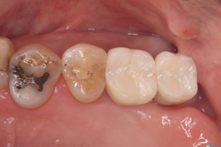 1Dayインプラント治療による咬合の再構築 治療後画像