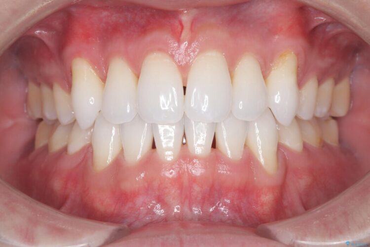 ガタつきと口元の突出感を抜歯ワイヤー矯正で改善 治療後画像