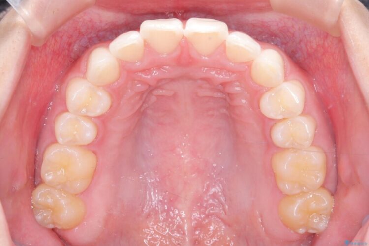 ねじれた前歯を非抜歯ワイヤー矯正で改善 治療後画像