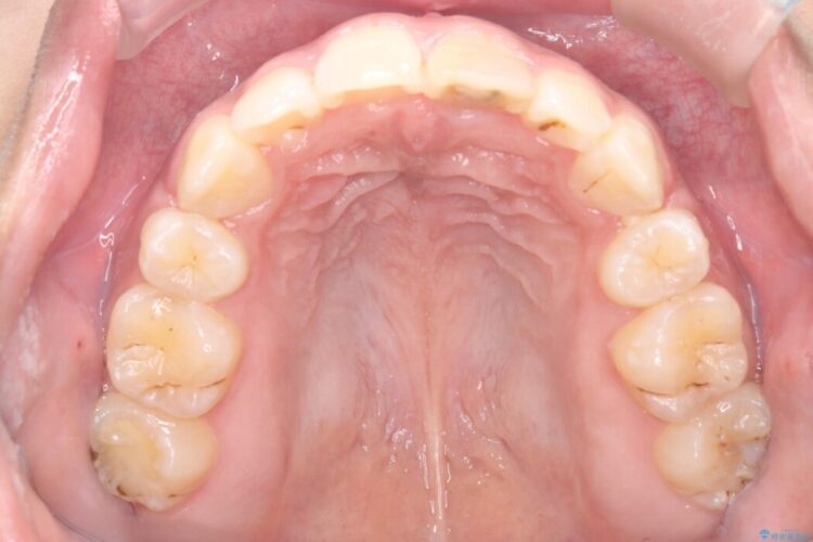 突出感のある口元、抜歯矯正で理想的な横顔に 治療後画像