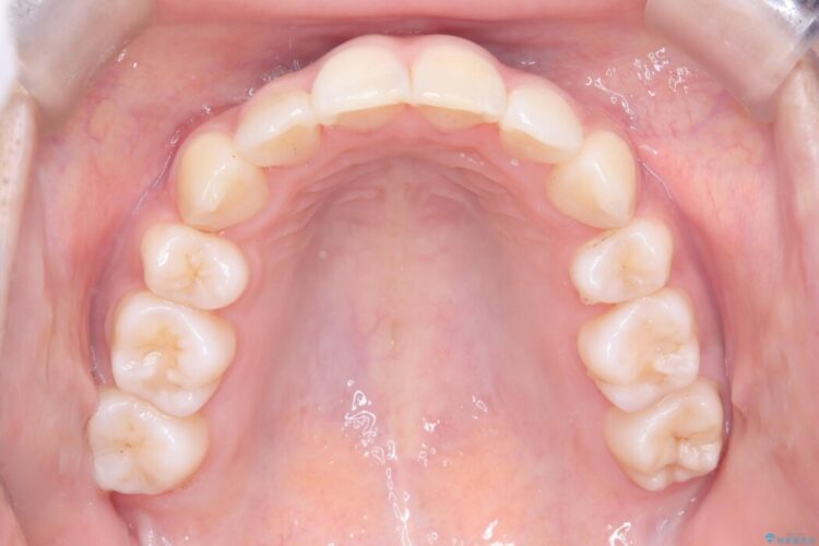 重なり合った歯列を整え、美しい横顔に 治療後画像
