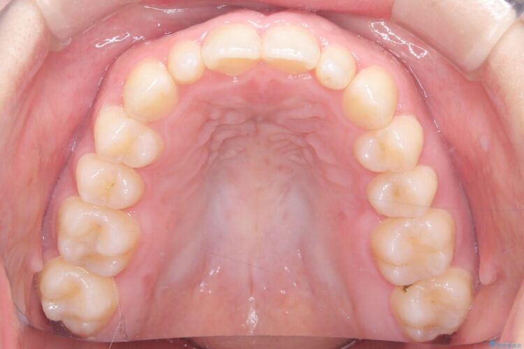 歯を削らない矮小歯を考慮した非抜歯矯正 治療後画像