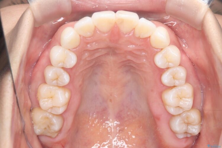 非抜歯で叢生とシザーズバイトの改善 治療後画像
