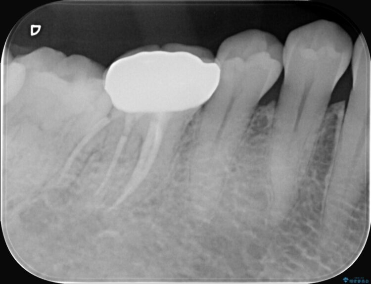 強い痛みと腫れを伴う「曲がった根っこ」を精密根管治療 治療後画像