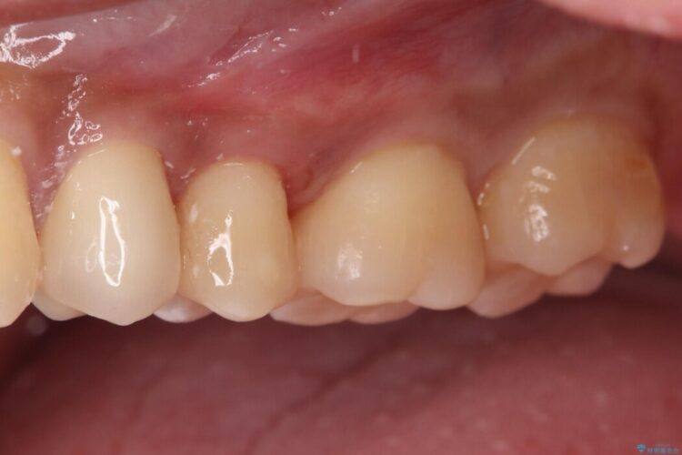 「痛み」を「安心」に。銀歯を外して行う、最新の精密根管治療 治療後画像