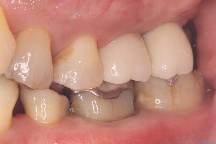 1Dayインプラント治療による咬合の再構築 治療後画像