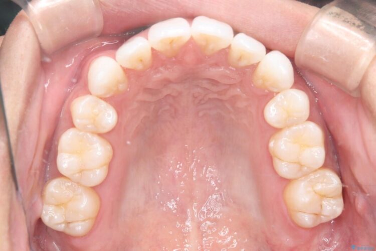 ガタつきと口元の突出感を抜歯ワイヤー矯正で改善 治療後画像