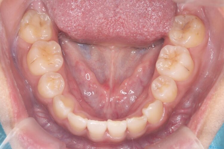 突出感のある口元、抜歯矯正で理想的な横顔に 治療後画像