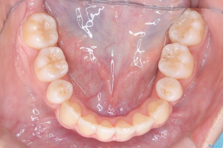 重なり合った歯列を整え、美しい横顔に 治療後画像