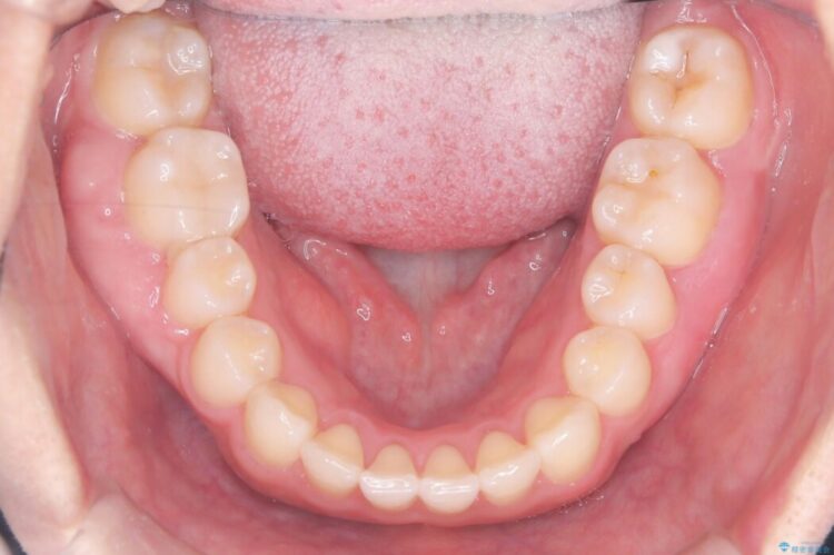 歯を削らない矮小歯を考慮した非抜歯矯正 治療後画像