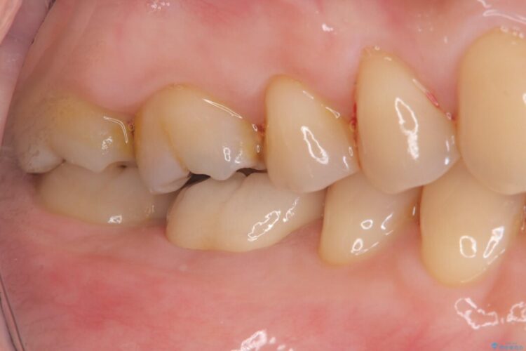 強い痛みと腫れを伴う「曲がった根っこ」を精密根管治療 治療後画像