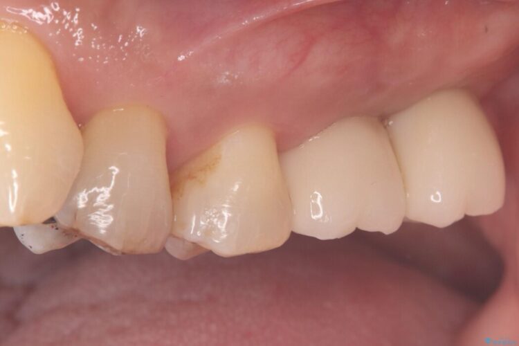 1Dayインプラント治療による咬合の再構築 治療後画像