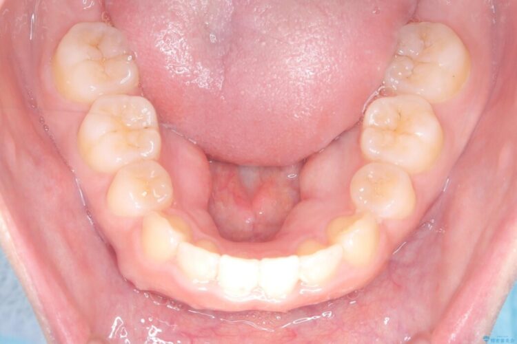 「口元の突出感」を解消。前歯を下げてスッキリした口元へ 治療後画像