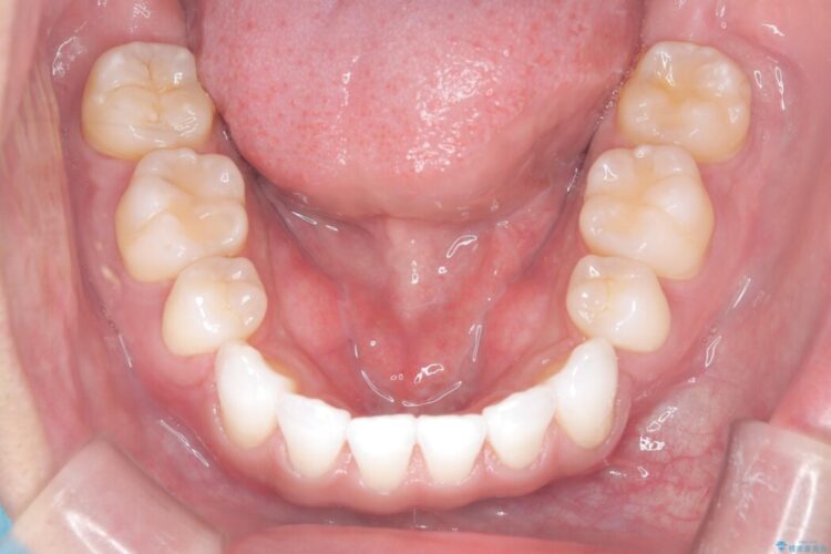 ガタつきと口元の突出感を抜歯ワイヤー矯正で改善 治療後画像