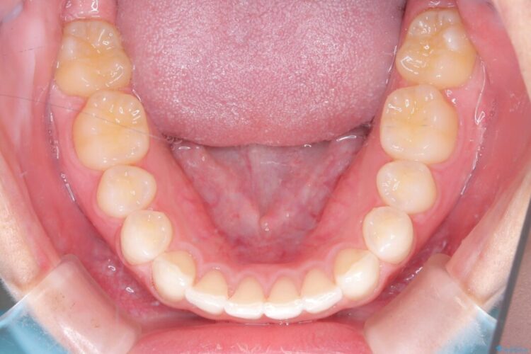 ねじれた前歯を非抜歯ワイヤー矯正で改善 治療後画像