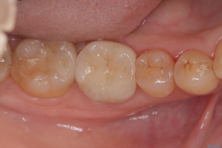 強い痛みと腫れを伴う「曲がった根っこ」を精密根管治療 治療後画像