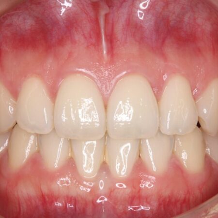 歯の黄ばみ、ここまで白く！ 治療前