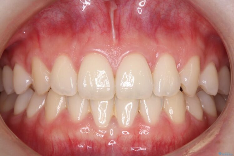 歯の黄ばみ、ここまで白く！ 治療前画像