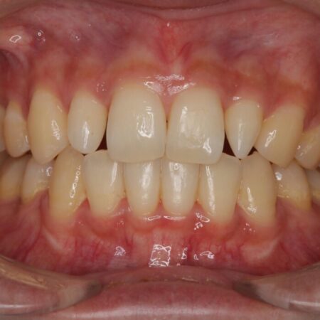 セラミック治療前のオフィスホワイトニング 治療前