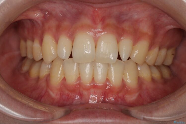 セラミック治療前のオフィスホワイトニング 治療前画像