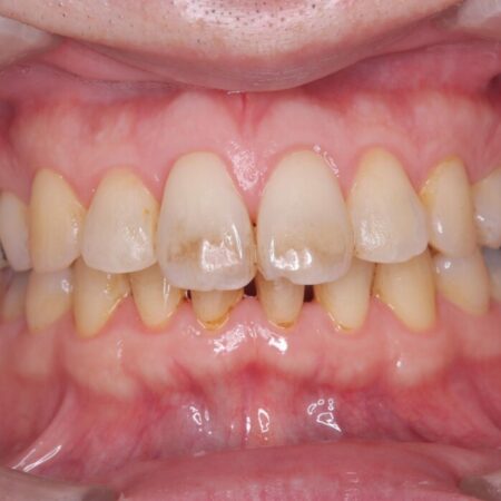 エアーフロークリーニング 治療前