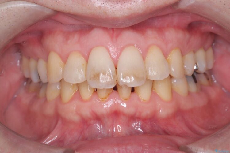 エアーフロークリーニング 治療前画像