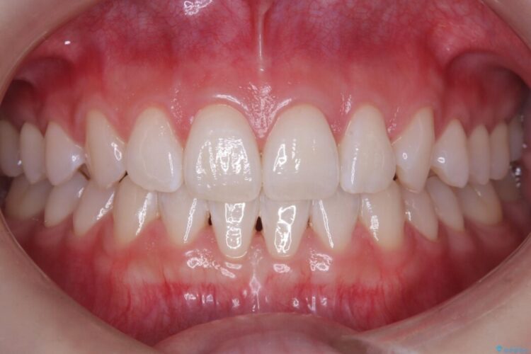 歯の黄ばみ、ここまで白く！ 治療後画像