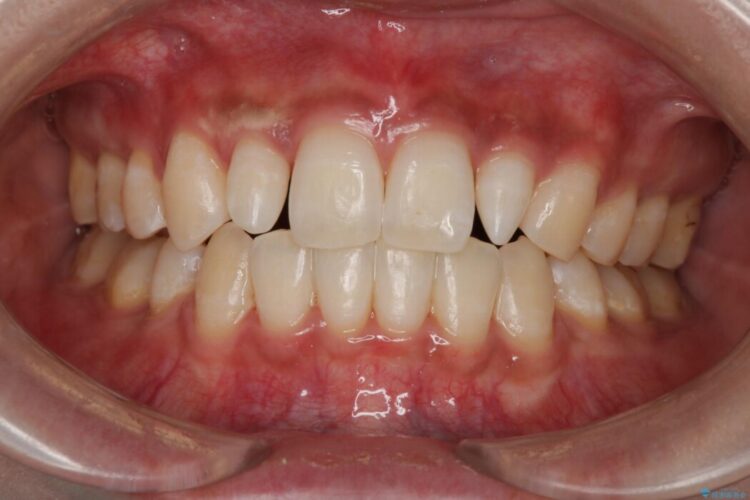 セラミック治療前のオフィスホワイトニング 治療後画像