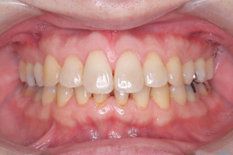 エアーフロークリーニング 治療後画像