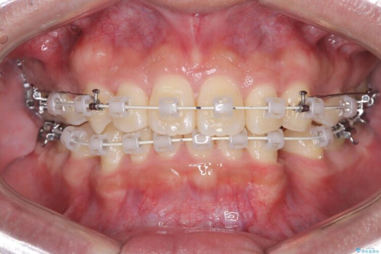 歯のガタつきと口元の突出感の改善 治療途中画像
