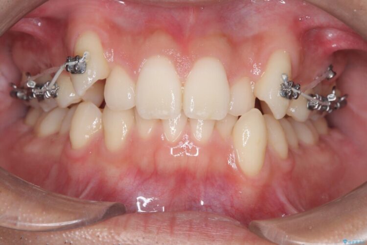 ワイヤー抜歯矯正治療で 治療途中画像